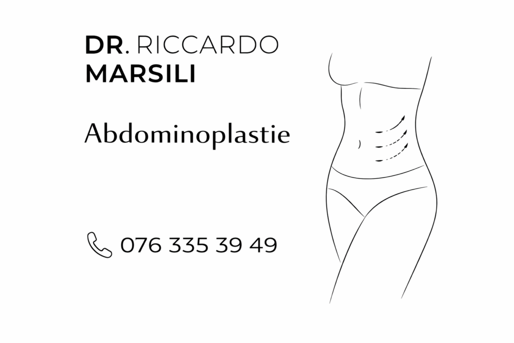 Tout savoir sur l&rsquo;abdominoplastie à Lausanne